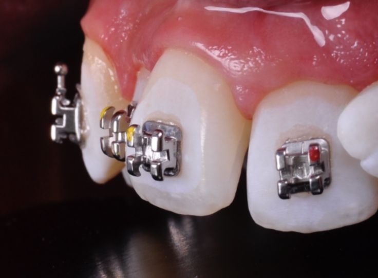 brackets metálicos