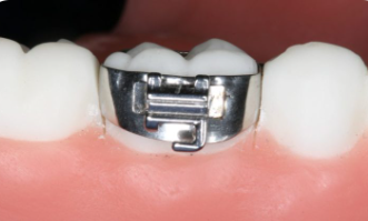 separadores dentales